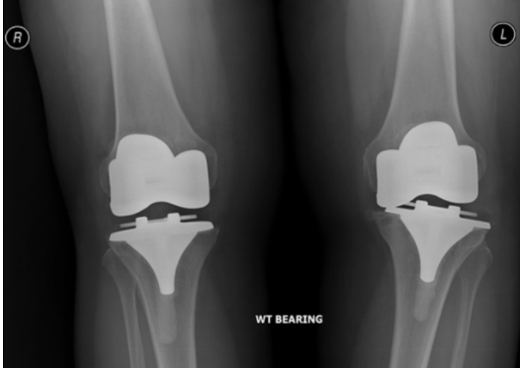 failed total knee replacement