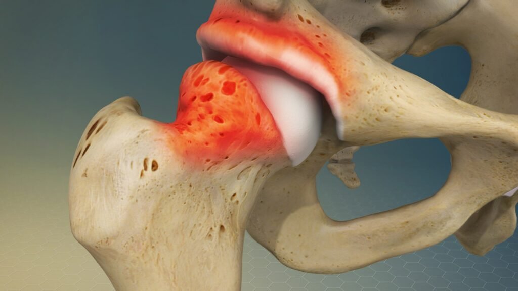 femoral acetabular impingement (fai)