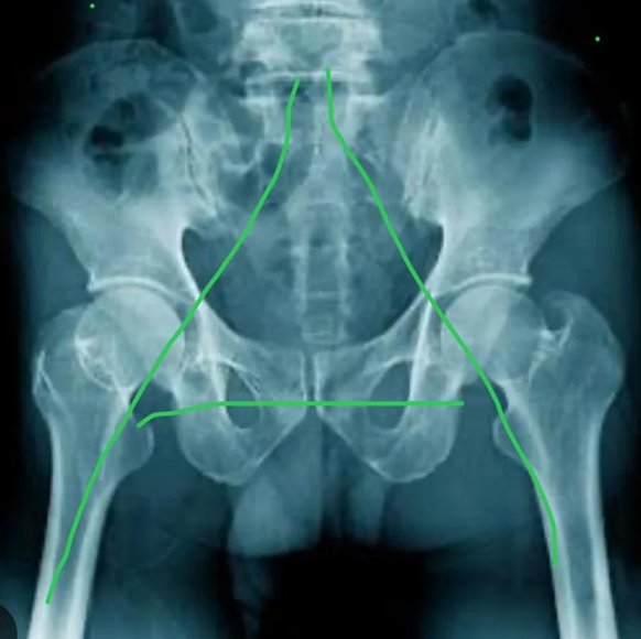 hip arthritis