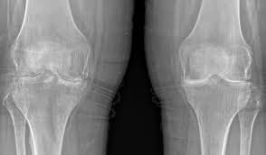 knee arthritis