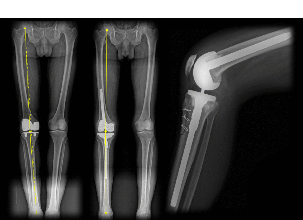 revision knee replacement