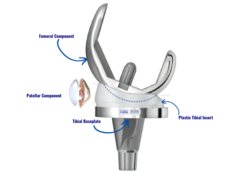 total knee replacement prosthetic components