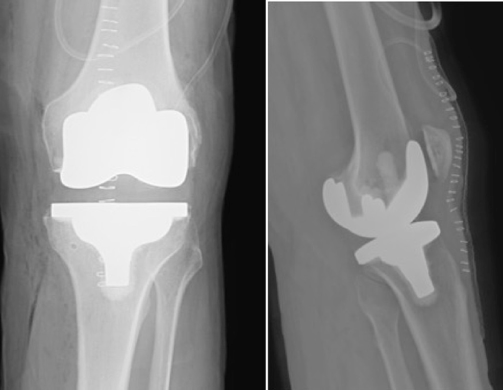 total knee replacement xray