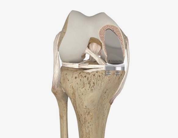 partial knee replacement sydney